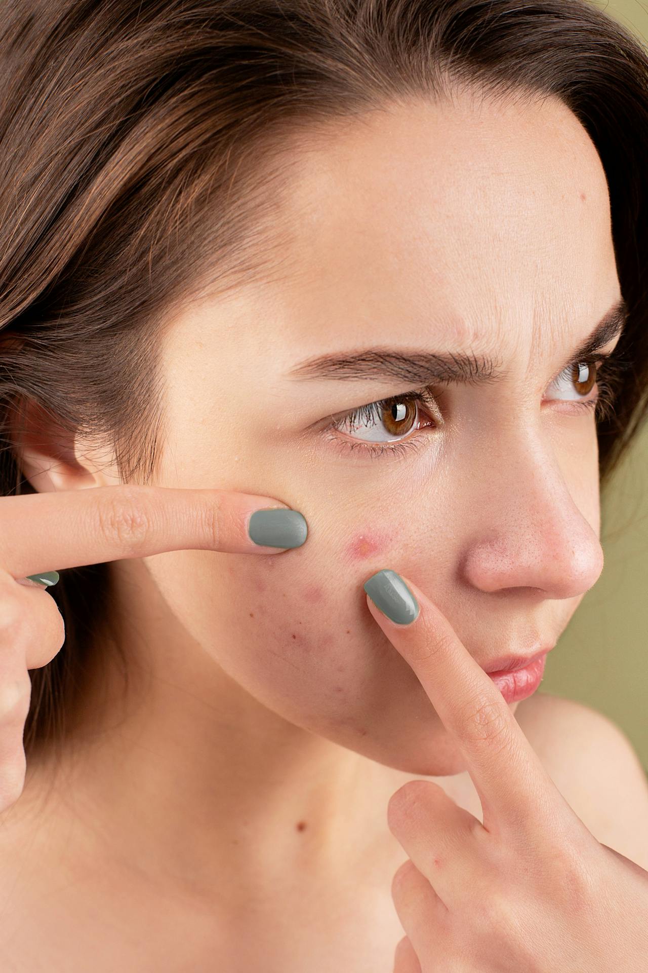 Acne-Prone Skin Treatment